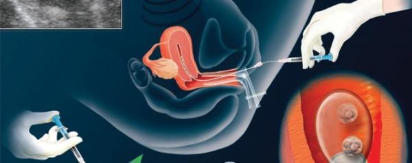 Embriyo Transferi Sonrasında Ne Yapılmalıdır?